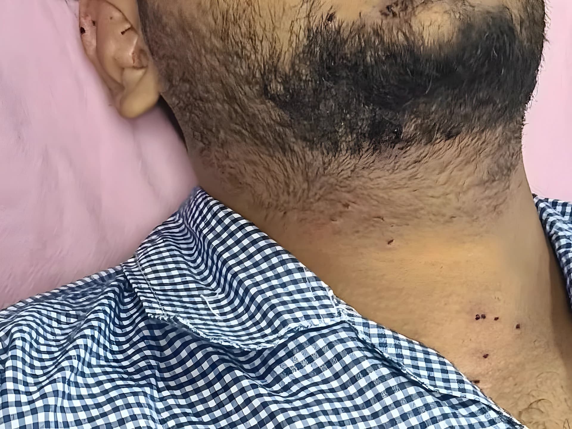 యువకుడి కంటిపై పెల్లెట్ ప్రభావం