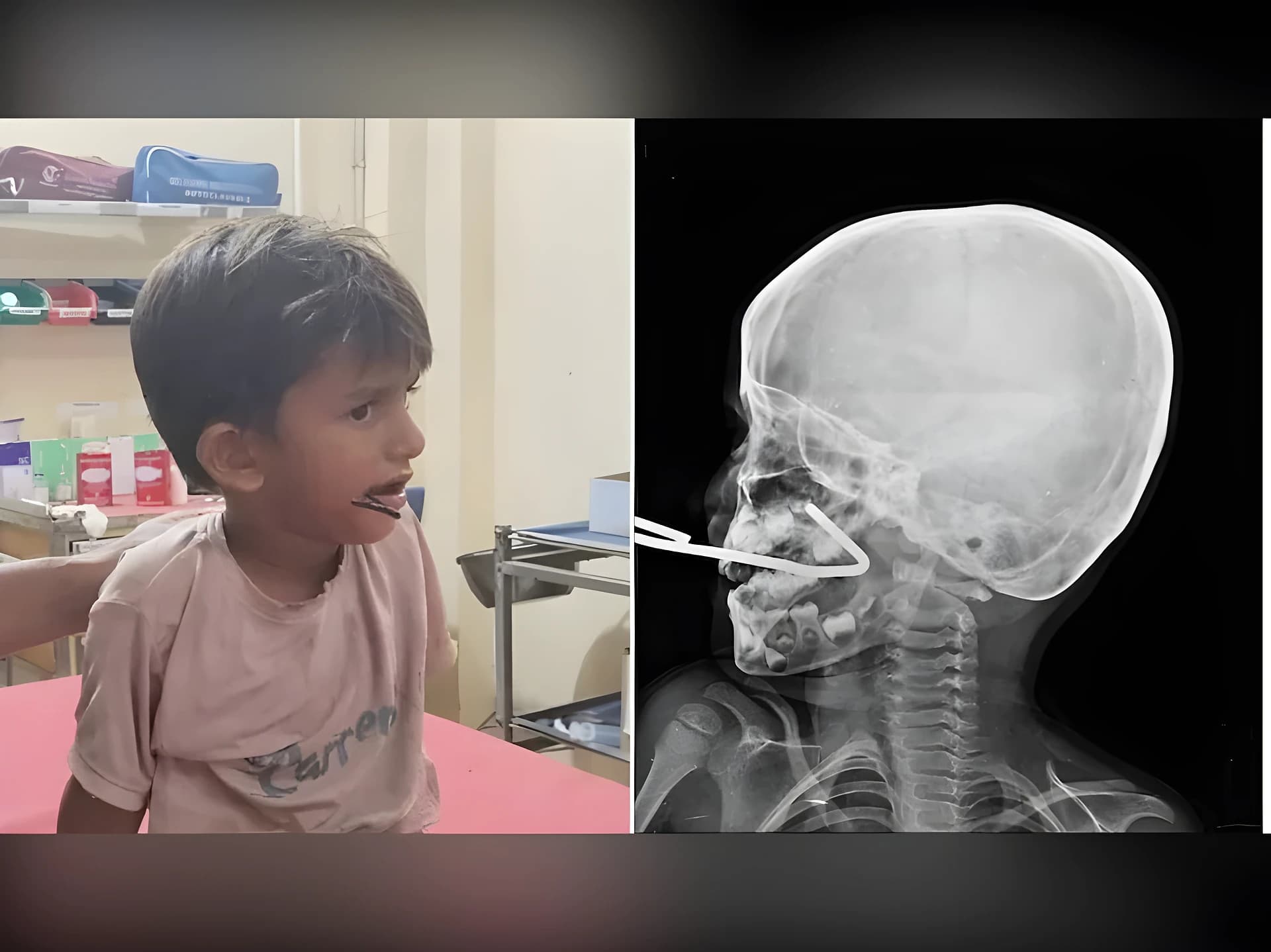 ఐదేళ్ల బాలుడి నోట్లో గుచ్చుకున్న ఇనుప రాడ్