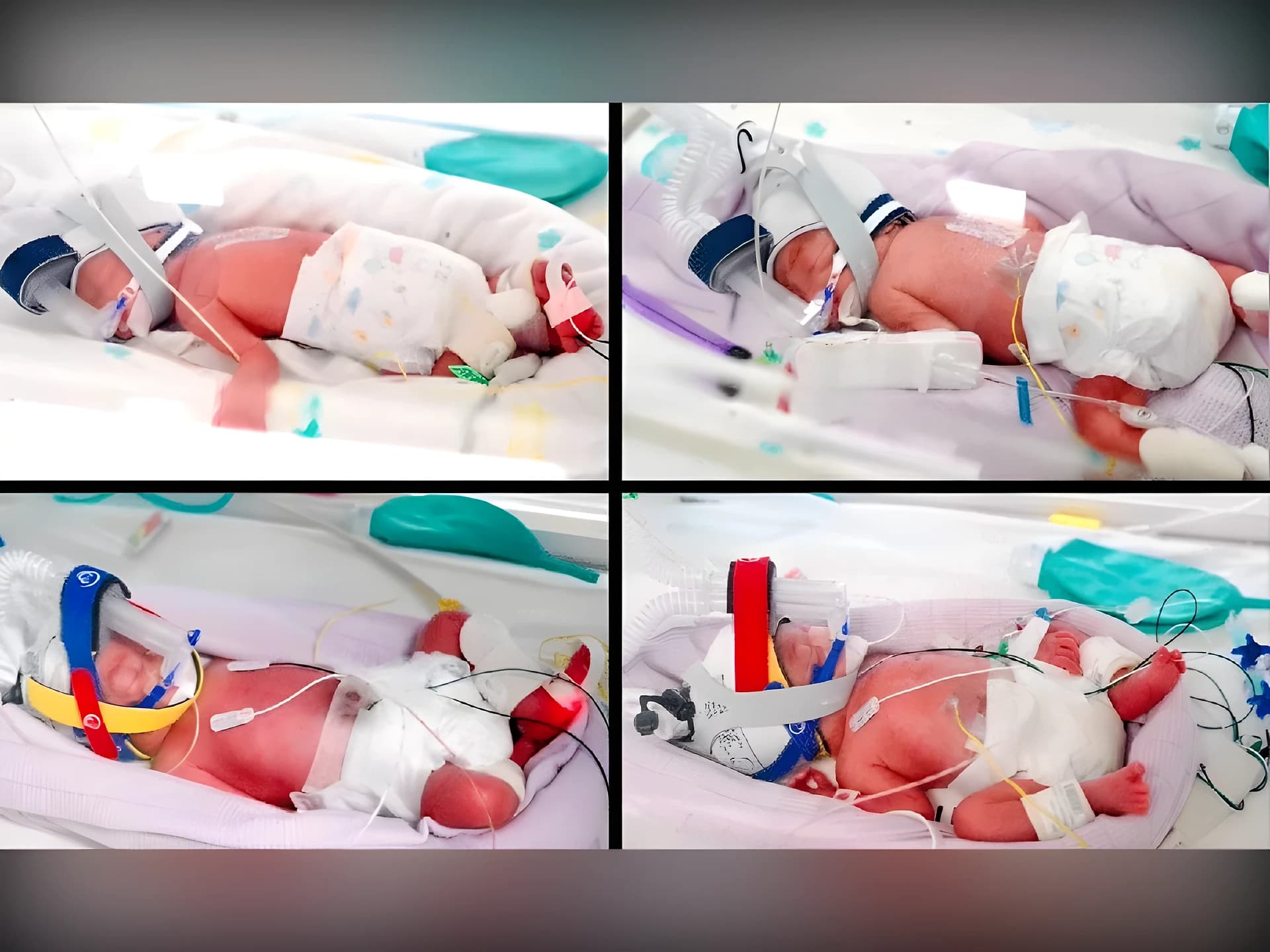 ఒకే కాన్పులో నలుగురు ఆడపిల్లల జననం
