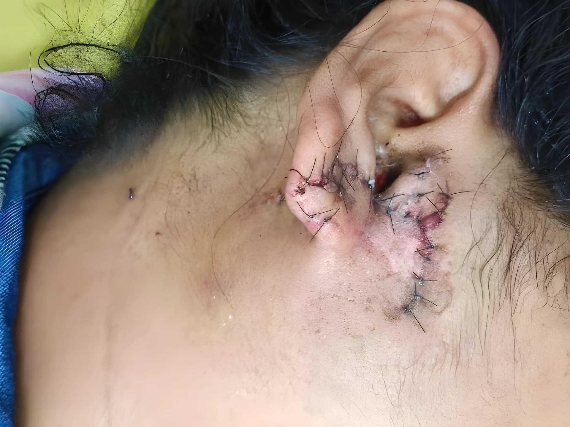 జంతర్ మంతర్ కాల్పుల్లో మహిళ చెవికి తీవ్ర గాయం !