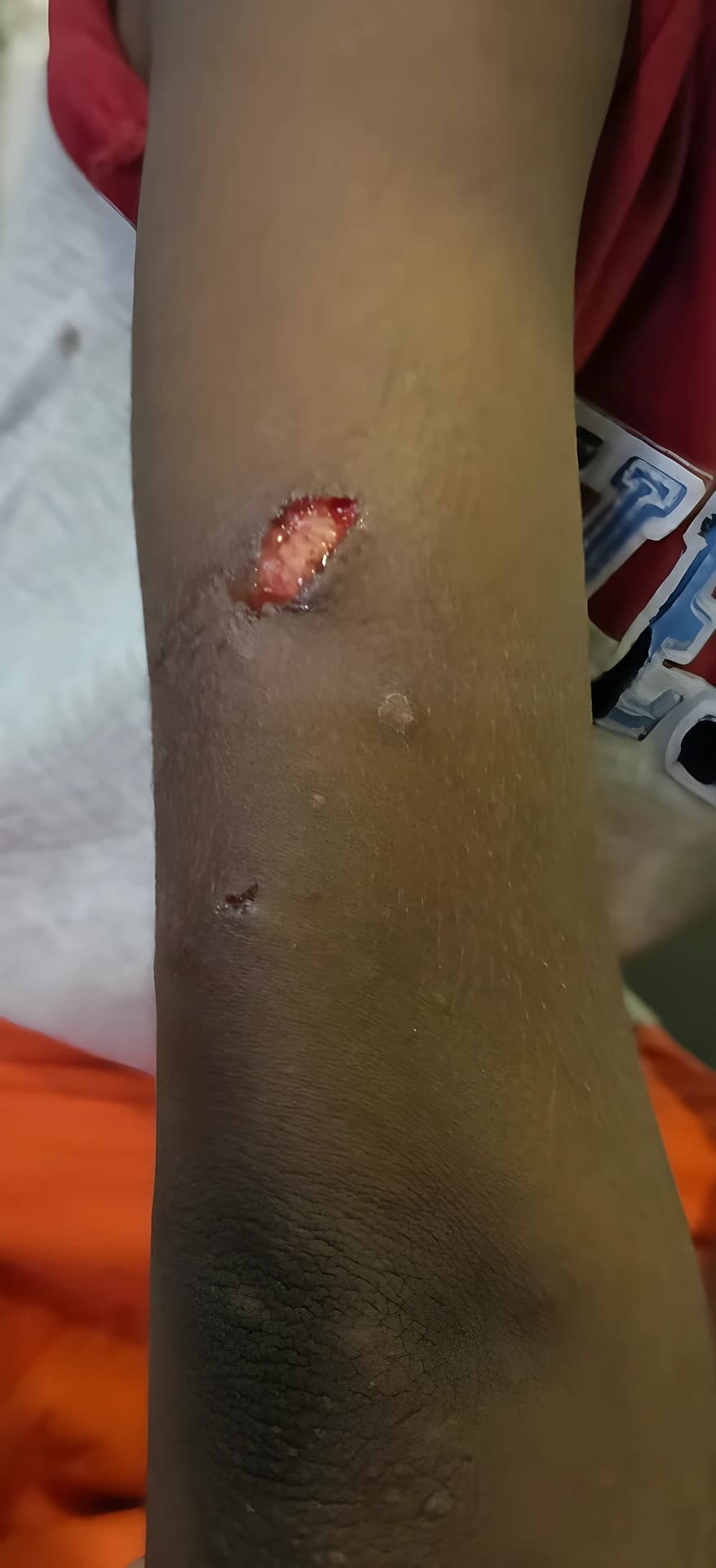 అయోధ్యలో కోతుల దాడి.. బాలుడికి తీవ్ర గాయాలు